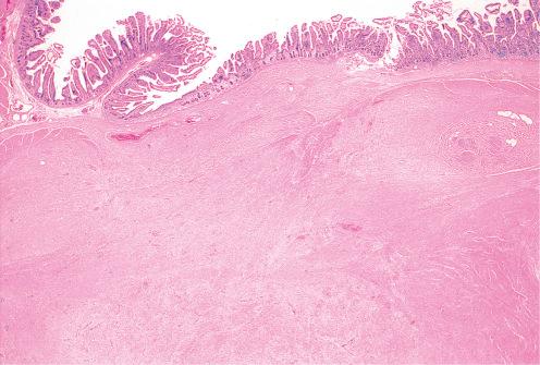 Fig. 9.4, Low-power view of mesenteric fibromatosis in Gardner syndrome showing uniform fibrocollagenous growth infiltrating wall of small bowel.