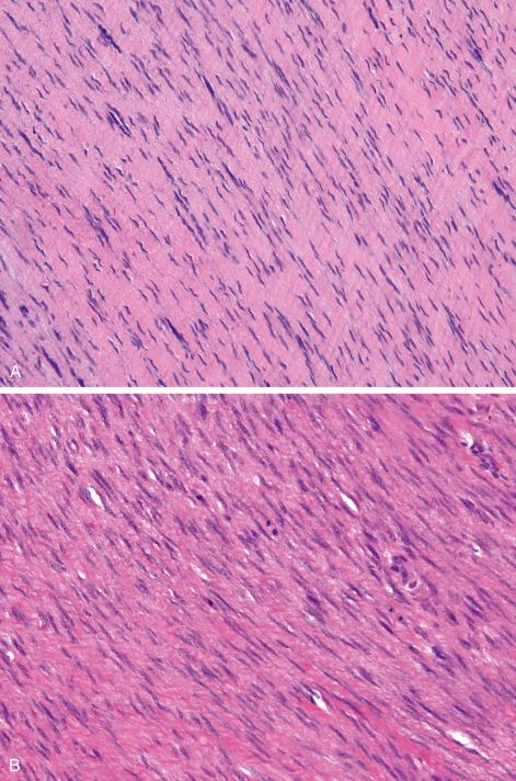 Fig. 9.7, Wavy, widely spaced cells arranged in parallel fashion often likened to a “school of fish” ( A ). Mitotic figures ( B ) and giant cells ( C ) may be seen in fibromatosis.