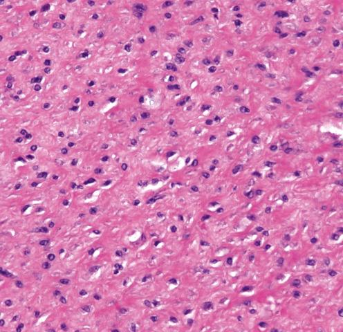 Fig. 9.9, Cross section of fascicle of fibromatosis showing rounded cell profiles.