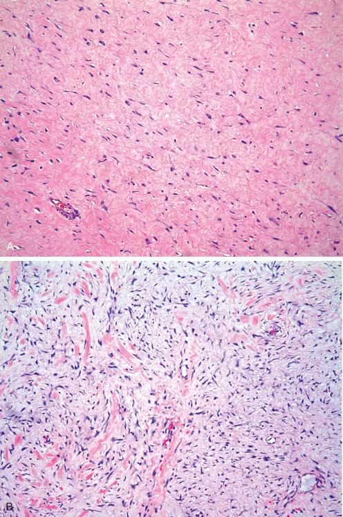 Fig. 9.10, Stromal variations in fibromatosis ranging from hyalinized ( A ) to myxoid ( B ) to keloidlike ( C and D ). Note fascicular pattern is not as apparent in these areas.