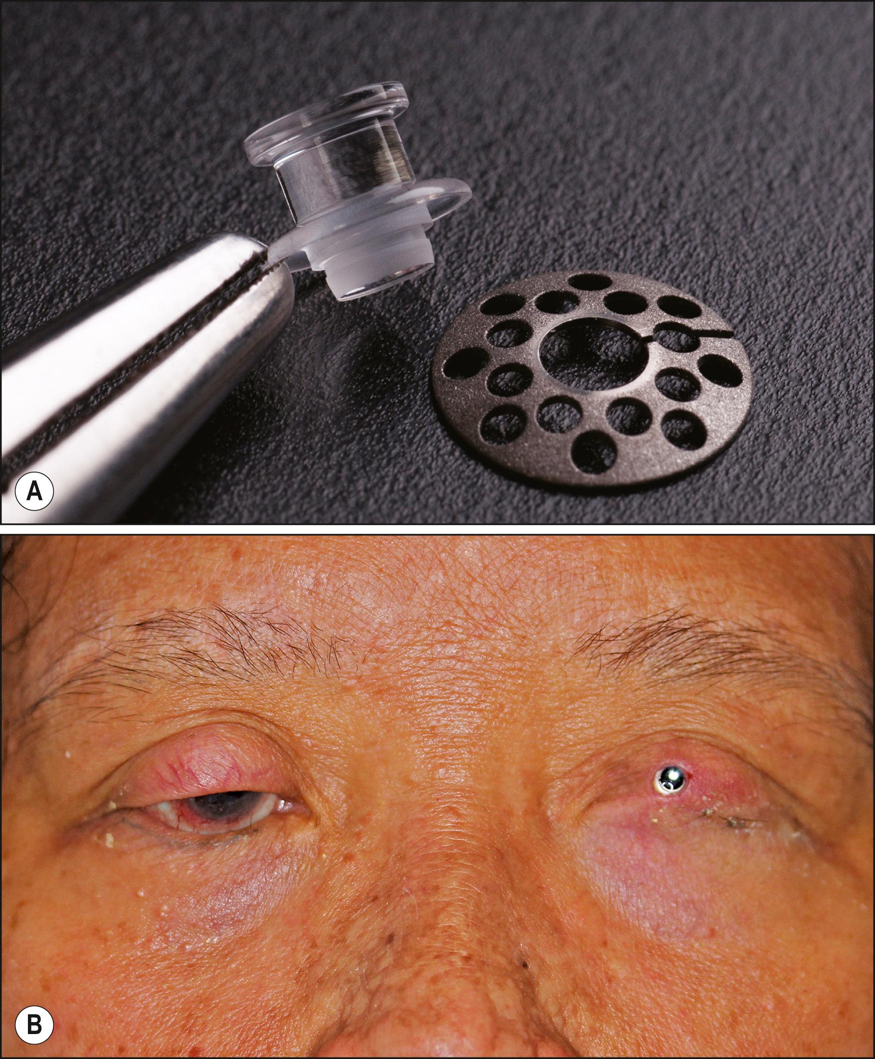 Fig. 160.1, Photomicrographs of Boston keratoprosthesis type 2. ( A ) The type 2 device is similar to the type 1 but has an anterior extension that allows for implantation through surgically closed eyelids. ( B ) The device in a patient’s left eye several years after implantation for corneal blindness in the setting of Stevens-Johnson syndrome.