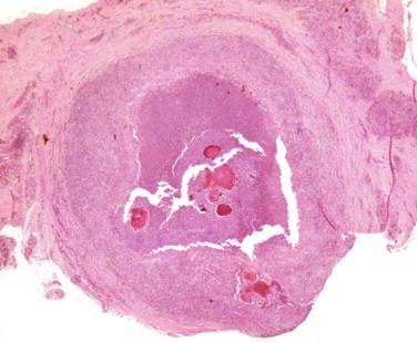 Figure 15-1, Lesion on the finger: eosinophilic granule surrounded by polymorphonuclear cells and histiocytes. H&E stain, 50 × magnification.