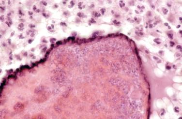 Figure 15-2, Lesion of the finger. Homogeneous eosinophilic granule and Splendore-Hoeppli phenomenon characterized by club-shaped filaments at the periphery. H&E stain, 40 × magnification.