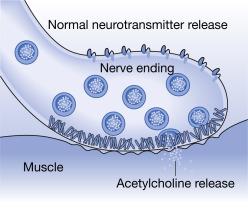 Fig. 60.2, Nerve conduction. An action potential reaches the nerve ending, triggering voltage-sensitive calcium channels to open. Calcium flux prompts preformed vesicles containing acetylcholine (ACH), and other neurotransmitters, to move toward, dock, and fuse with the presynaptic membrane. The ACH is released into the presynaptic cleft and taken up by the postsynaptic muscle, resulting in depolarization and contraction.