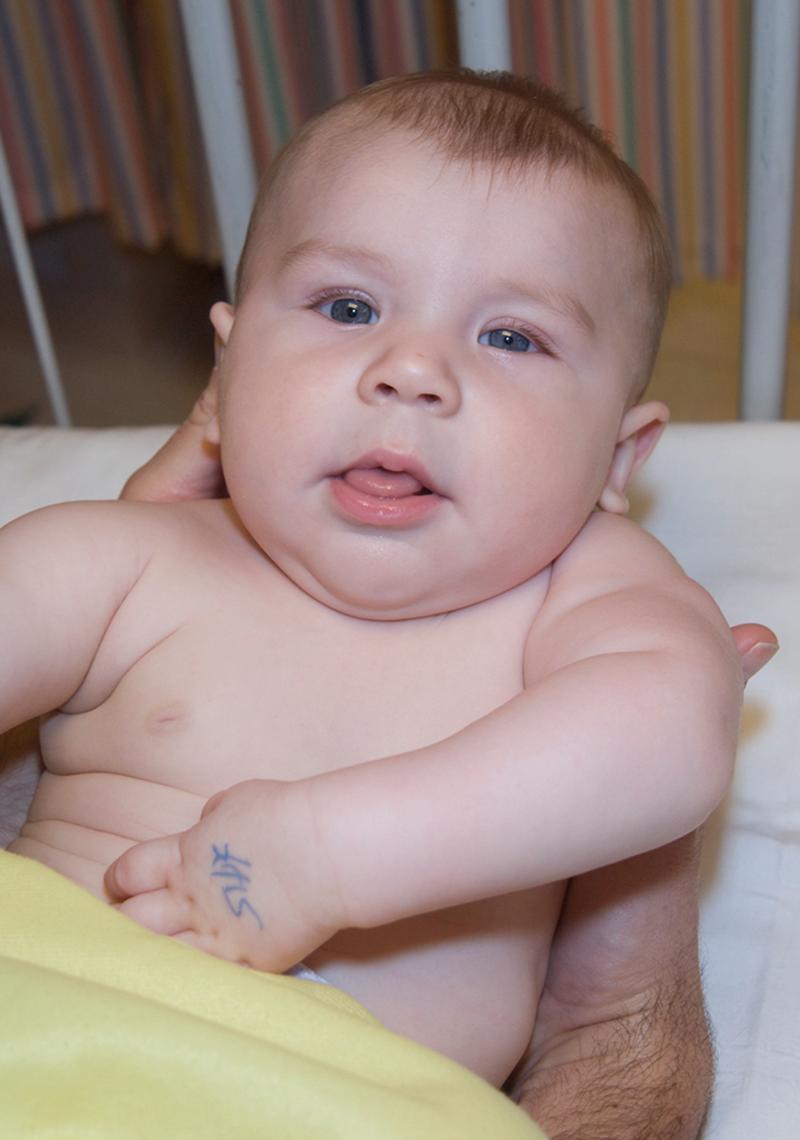 Fig. 40.3, A 4-month-old child with left global brachial birth palsy and Horner’s syndrome.