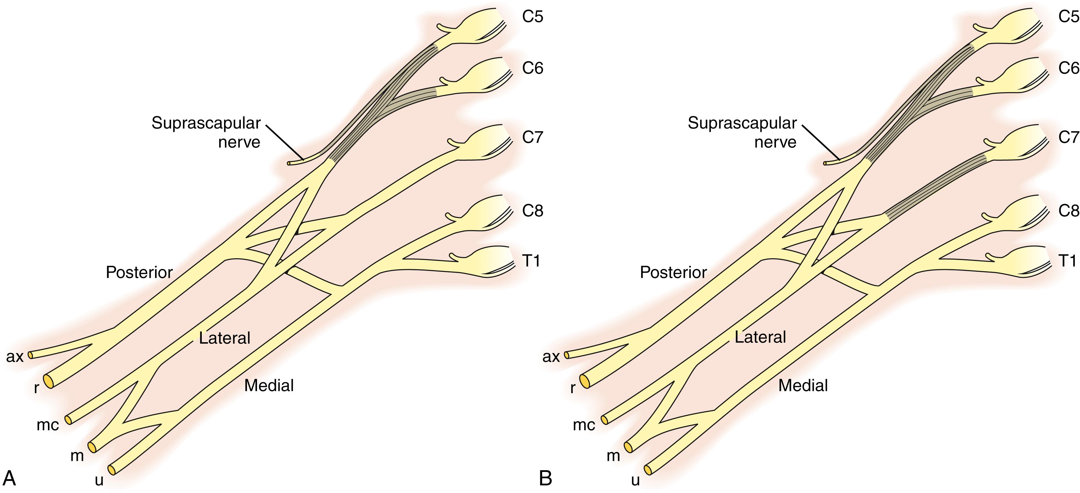 Fig. 40.5, A and B, Nerve grafting strategies for upper trunk rupture. ax, Axillary; m, median; mc, musculocutaneous; r, radial; u, ulnar.