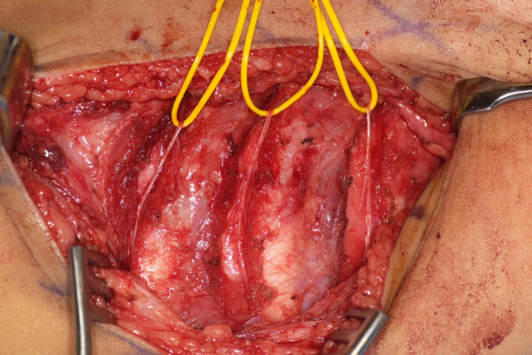 Fig. 40.6, A 9-month-old with harvest of three intercostal nerves prior to transfer.