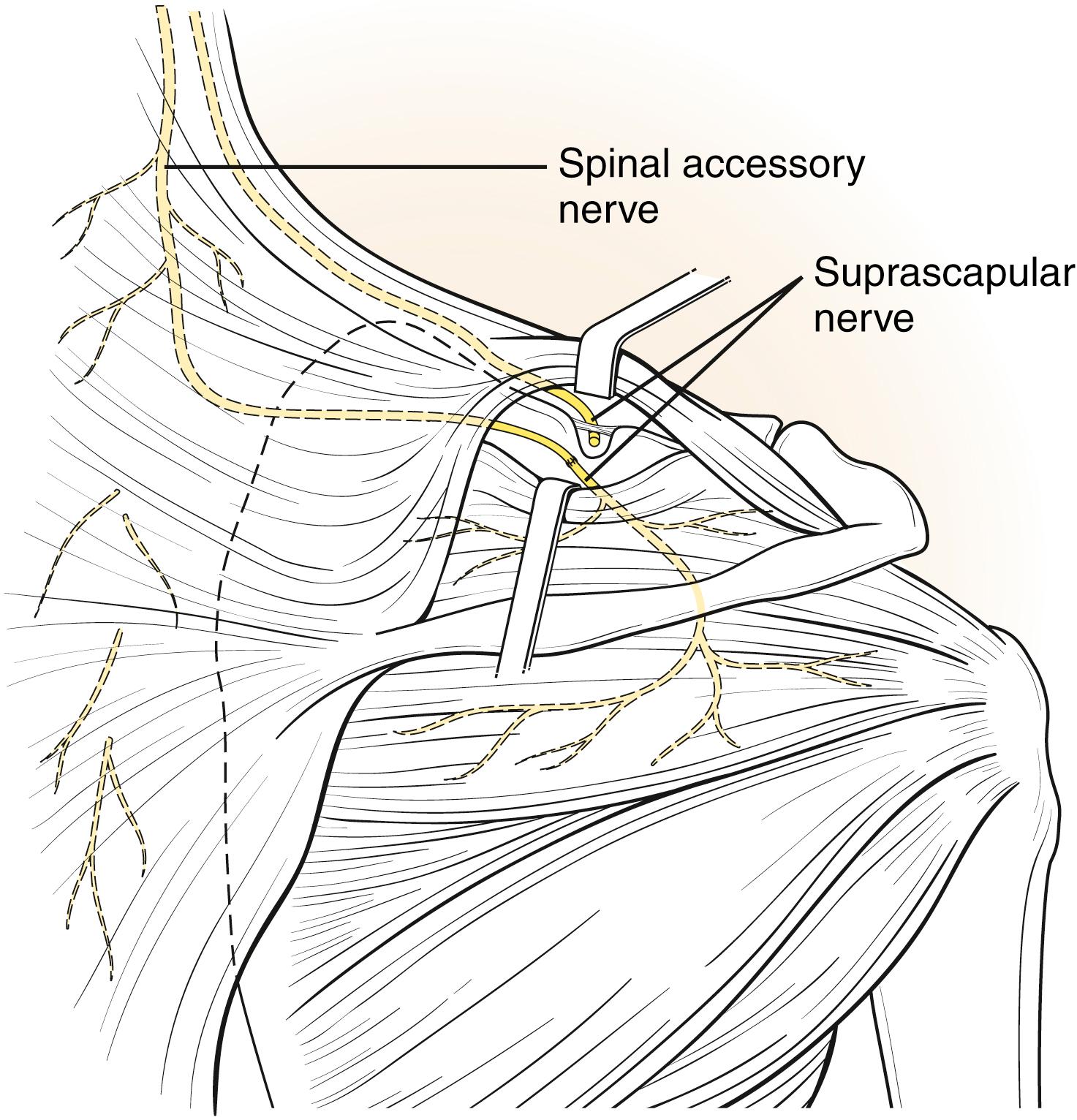 Fig. 40.8, Schematic representation of a distal spinal accessory nerve transfer to the suprascapular nerve using the posterior approach. The proximal fibers innervating the superior and middle aspect of the trapezius muscle have been preserved, thus preventing a drooped shoulder.