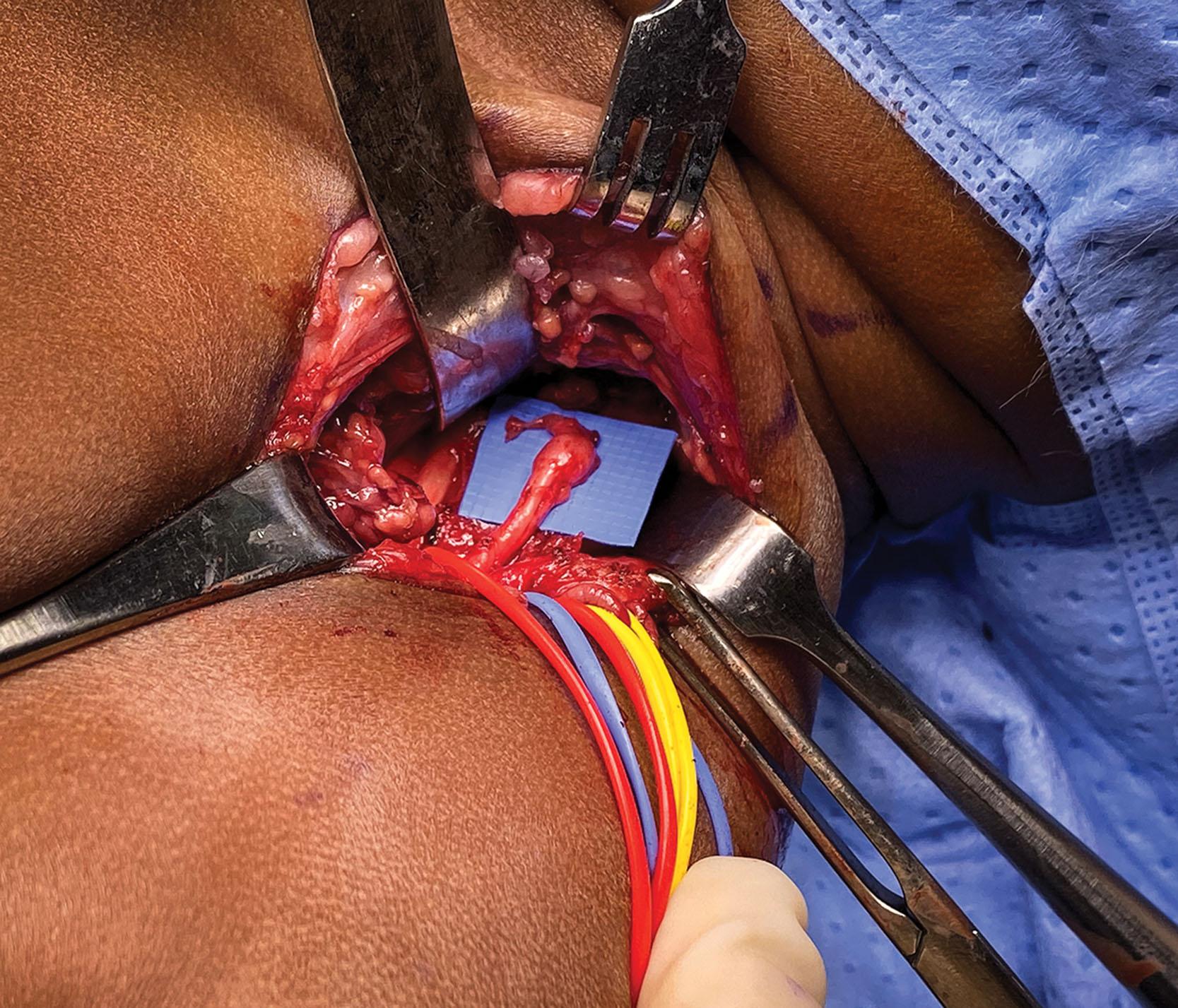 Fig. 16.1, The Brachial Plexus is Exposed Through a Transverse Incision. This extends from the lateral border of sternocleidomastoid to the medial border of trapezius. The patient’s head is at the upper righthand corner, and the patient’s shoulder is at the lower edge of the image.