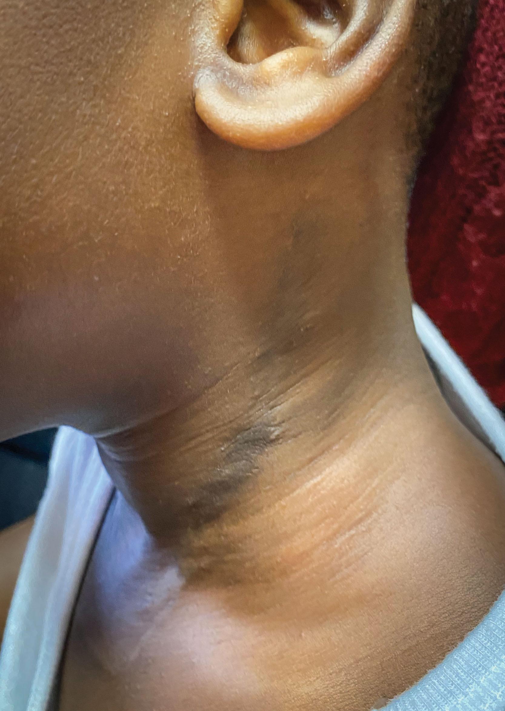 Fig. 16.2, Hypertrophic Scar From a Longitudinal Incision for Brachial Plexus Exposure.