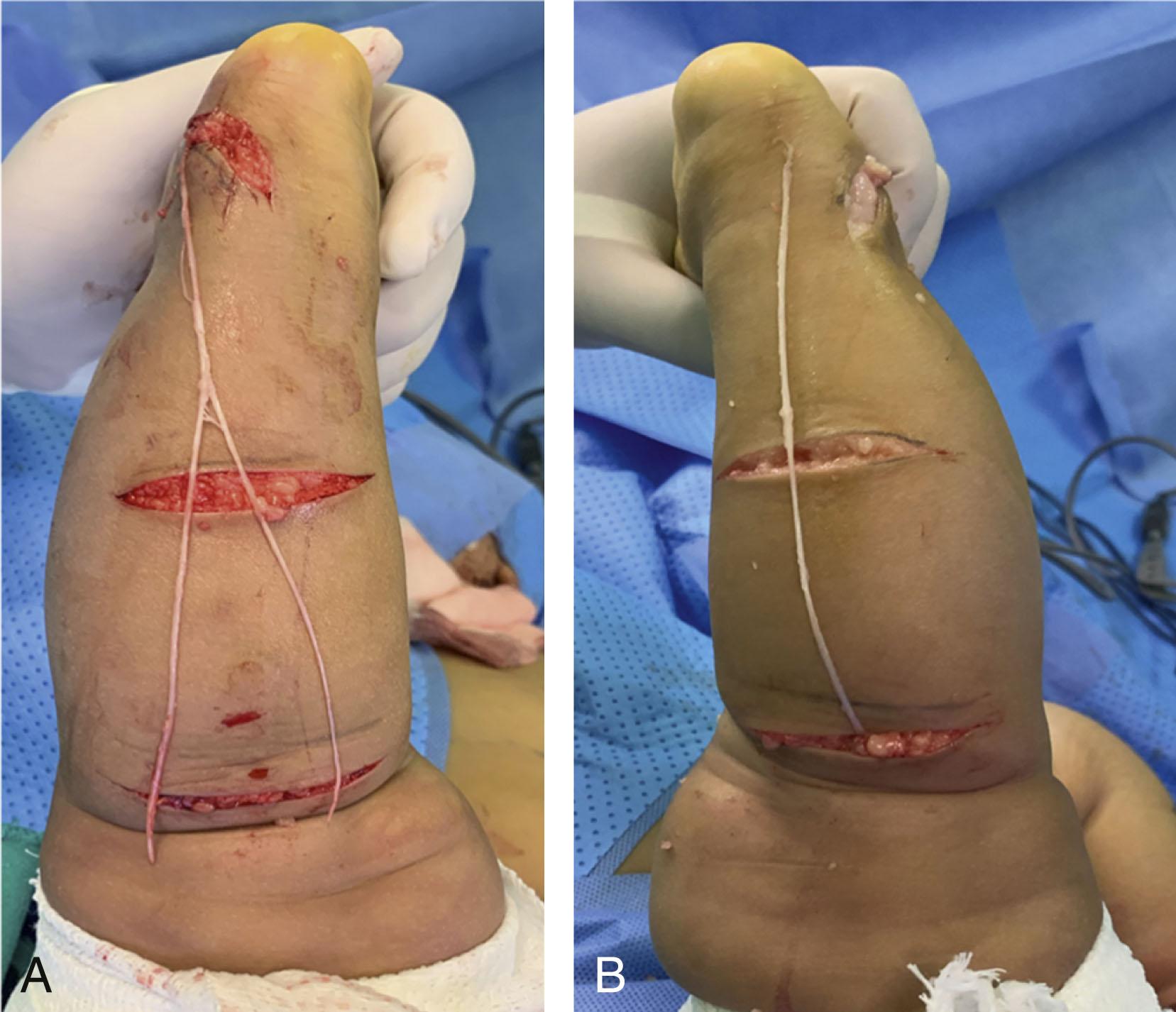 Fig. 16.3, Stepwise Incisions for Sural Nerve Harvest Follow Langer’s Lines and Minimize Unsightly Scarring. (A and B) Demonstrate variability in convergence of the medial and lateral sural nerves.