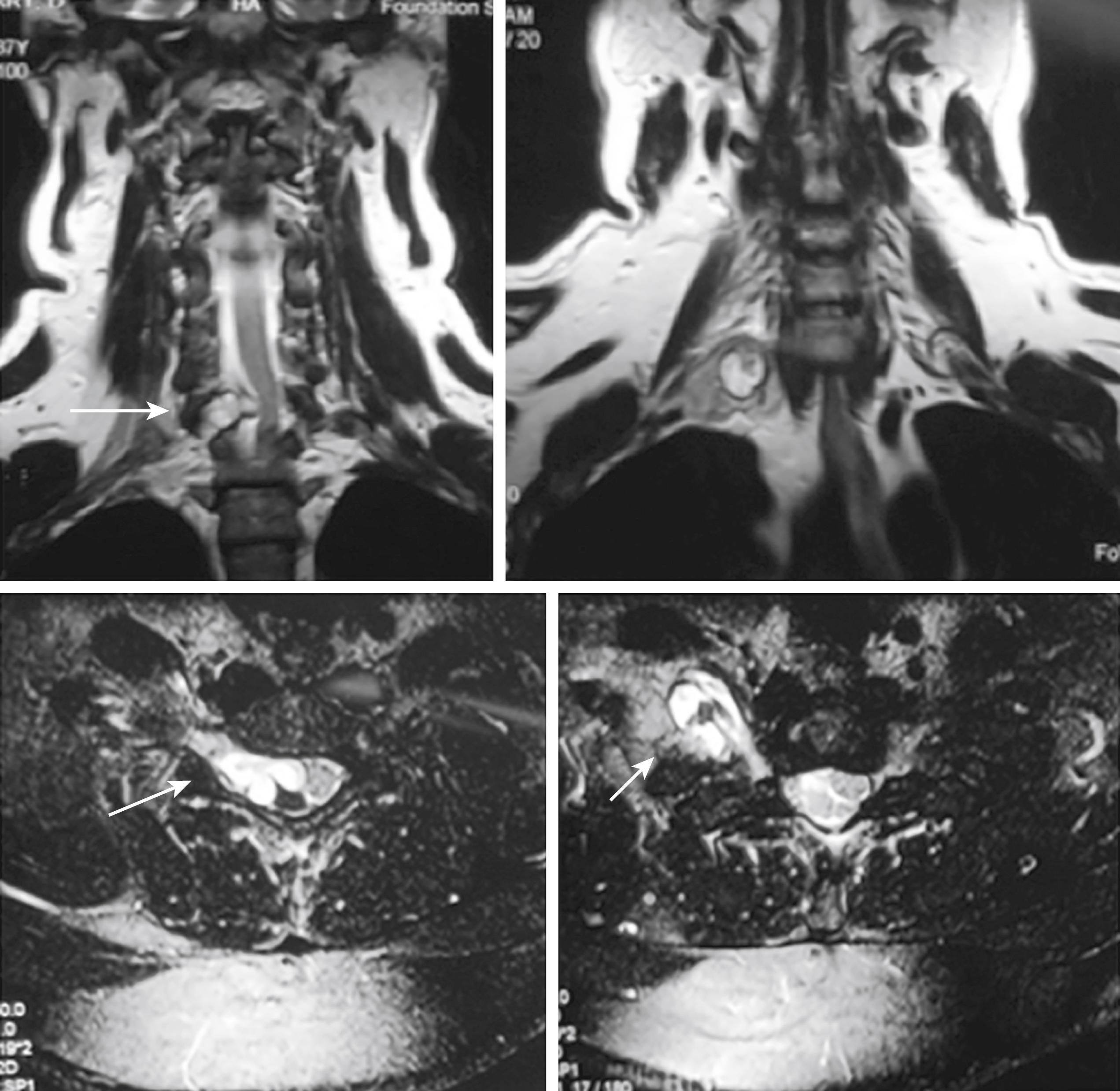 Fig. 50.2, Preoperative axial and coronal T2-weighted magnetic resonance image of a 39-year-old male demonstrating a hyperintense mass along the course of the C7 spinal nerve. Characteristic cystic changes with heterogeneity as seen in schwannomas are marked by the white arrows. There is displacement and compression of the spinal cord, and the tumor extends along the extraforaminal course of C7.