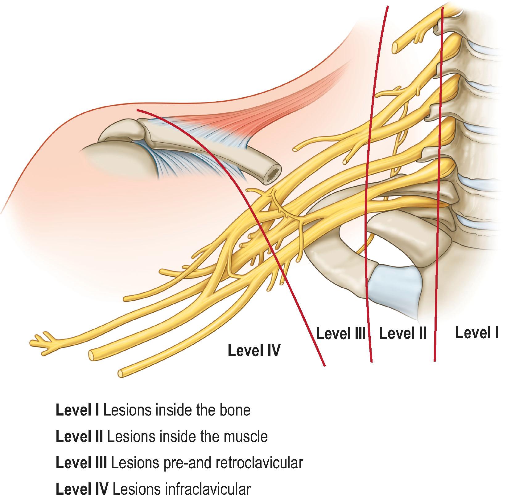 Figure 23.1, Anatomy and numbered level of brachial plexus injury (see the text).