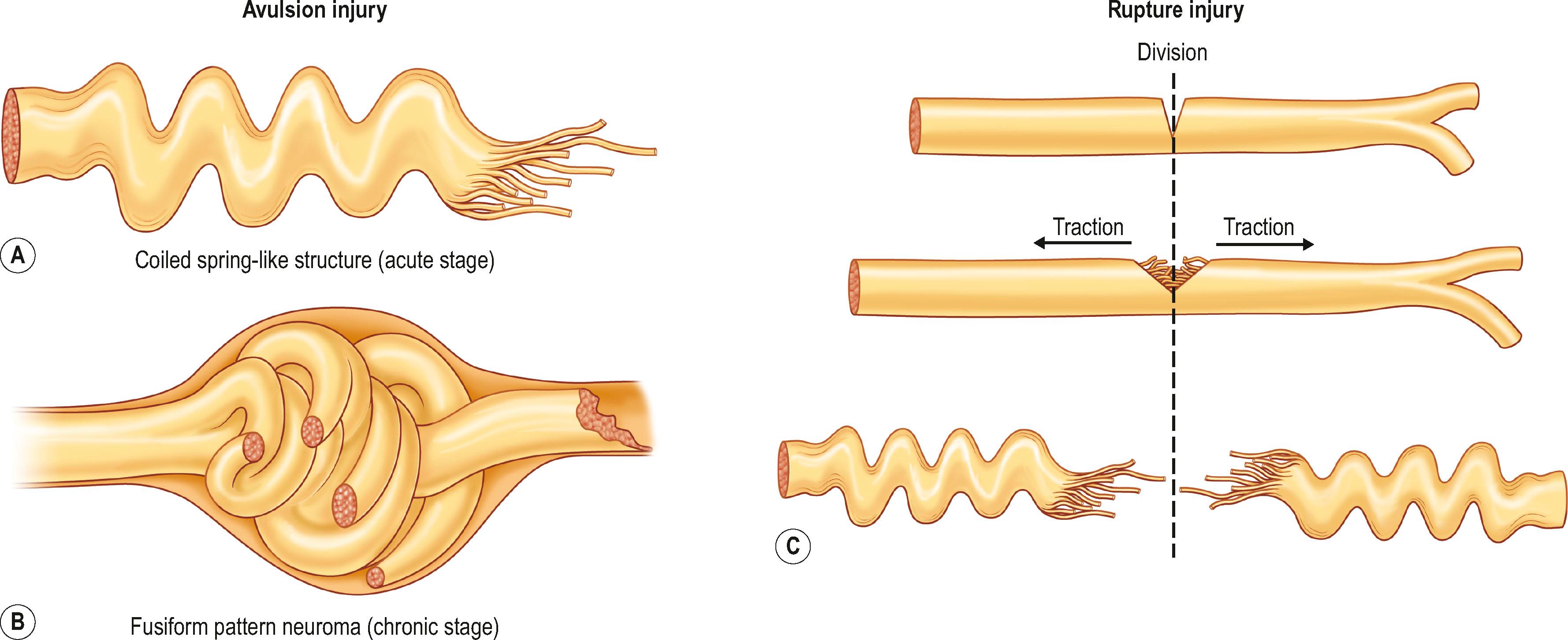 Figure 23.3, The drawing shows the mechanism of avulsion (A,B) vs. rupture (C) injury.