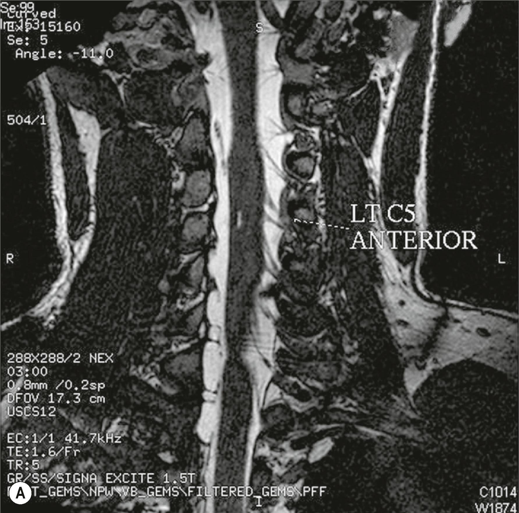 Figure 23.6, (A) Right C5-T1 avulsion cysts on the coronary view using magnetic resonance imaging (MRI) three-dimensional (3D) fast imaging employing steady-state acquisition (FIESTA) technique, (B) on the sagittal view, using MRI 3D FIESTA and curve planar reformat techniques; and (C) MRI cervical spine myelogram on the same patient. (D) MRI 3D, coronal view, avulsion cyst of the left C7, and (E) axial view for comparison. (F) MRI 3D diffusion-weighted imaging (DWI) techniques to see the level II spinal nerves.