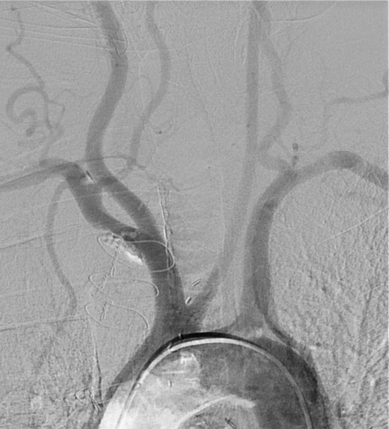 Figure 102.1, “Bovine arch” anatomy with common origin of innominate and left common carotid artery.