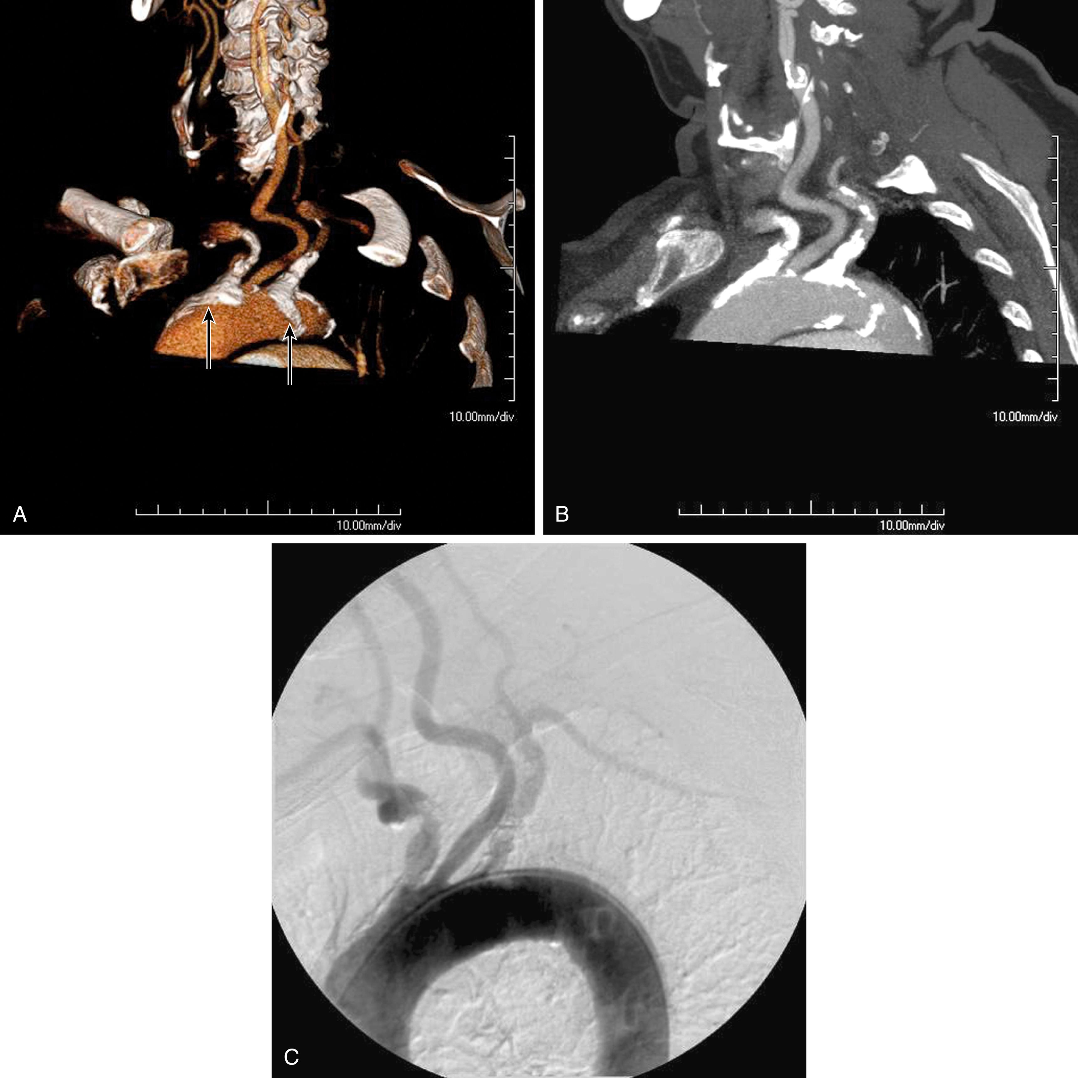 Figure 102.2, ( A ) CT three-dimensional surface rendering of the aortic arch showing severe calcific disease of the origins of the innominate and left subclavian arteries (arrows) . ( B ) Maximum intensity projection images of the same patient reconstructed from the CT scan. ( C ) Arteriogram of the same patient. Note extensive calcification at the origins of the innominate and proximal left subclavian arteries.