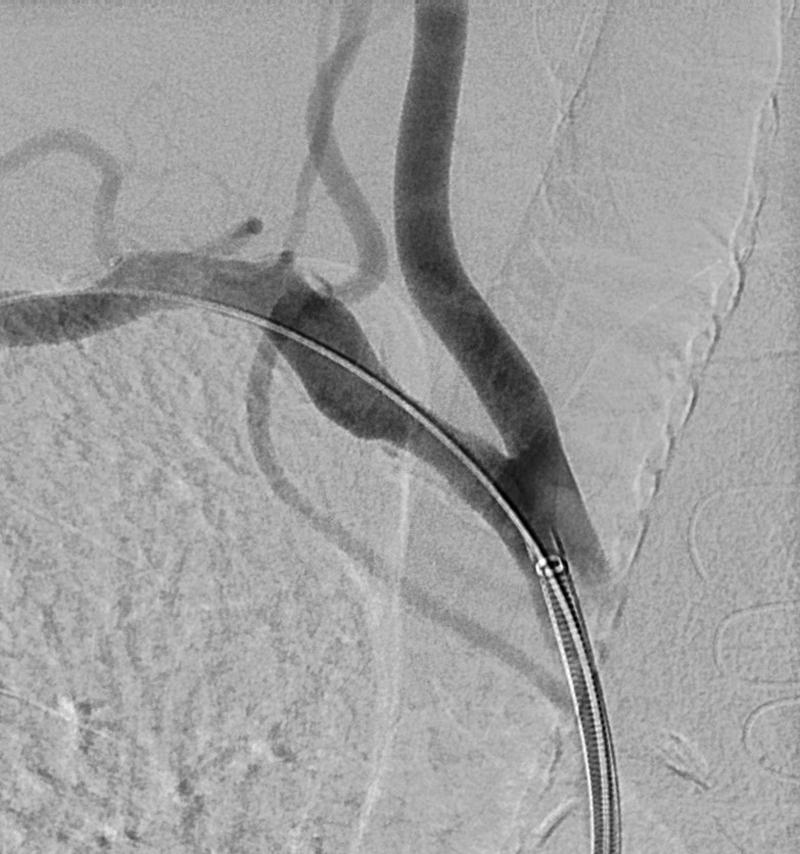 Figure 102.3, Maximum separation of the origins of the branches of the innominate artery in a right anterior oblique projection of approximately 20 degrees.