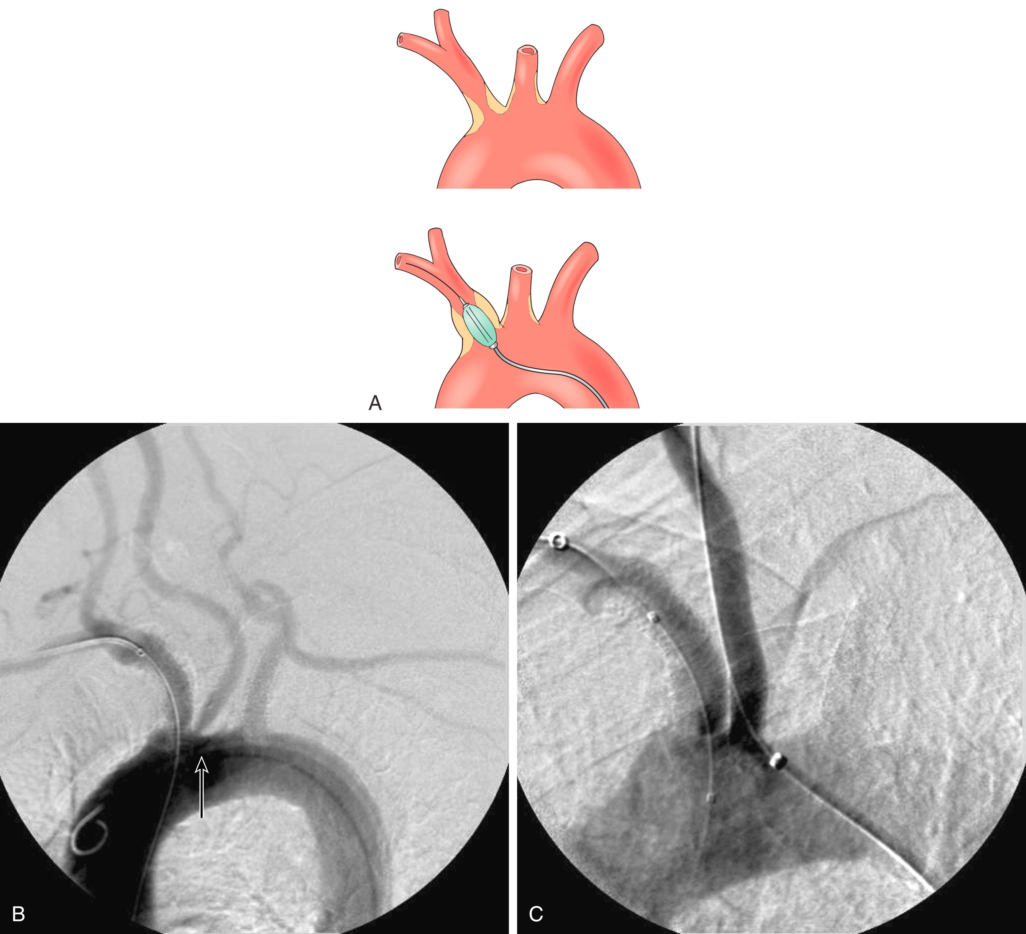 Figure 102.4, ( A ) Treatment of a neighboring arch vessel can force treatment of an adjacent arch branch. After treatment of the innominate artery, the left common carotid can be impinged on by a shift of aortic plaque, thus necessitating intervention in the left common carotid origin. ( B ) A successfully treated innominate artery has shifted aortic plaque, which resulted in stenosis at the origin of the left common carotid artery ( arrow ). ( C ) Treatment of the common carotid origin and simultaneous protection of the innominate artery’s stented origin.