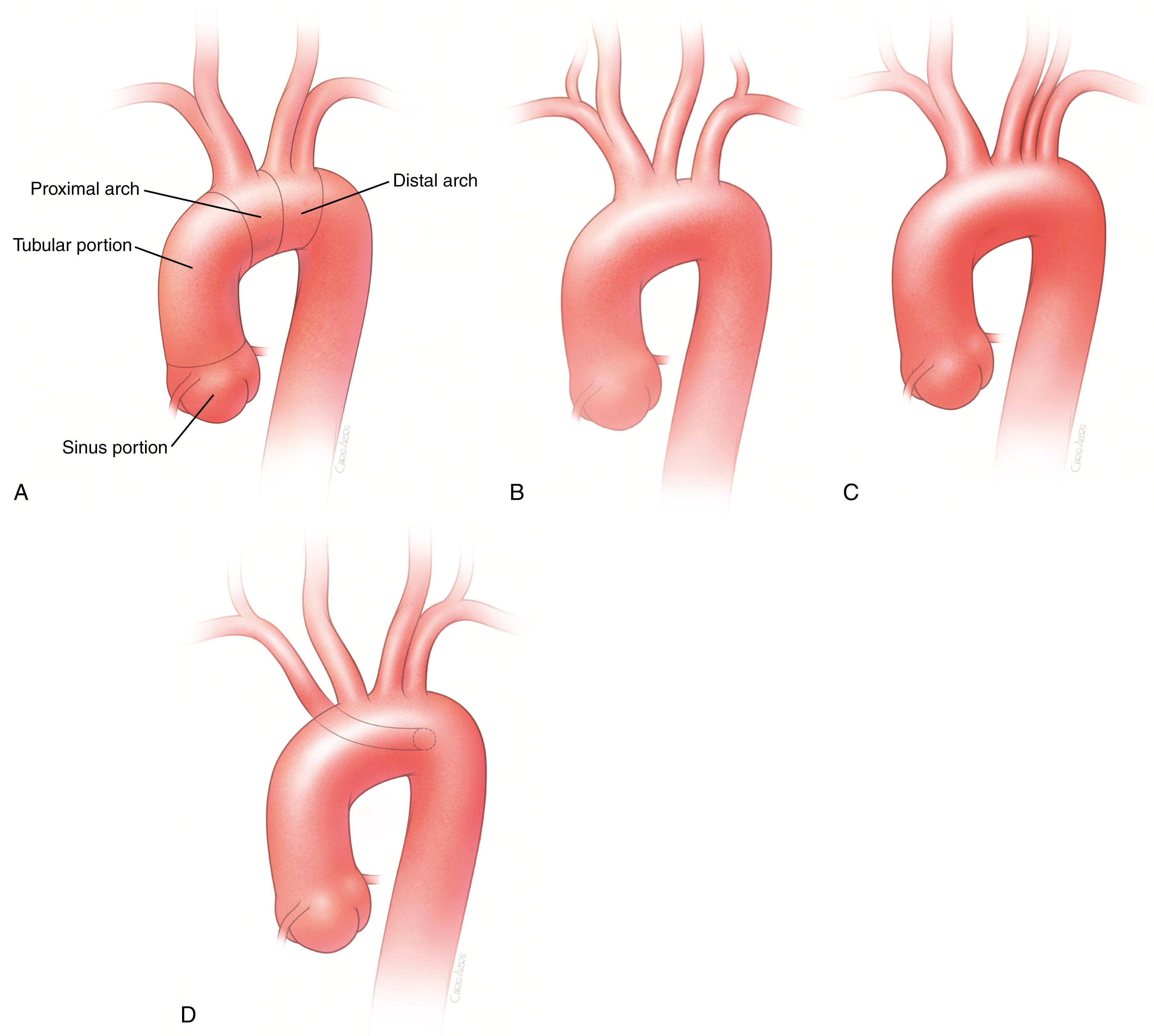 Figure 101.1, Normal and Variant Aortic Arch Anatomy.