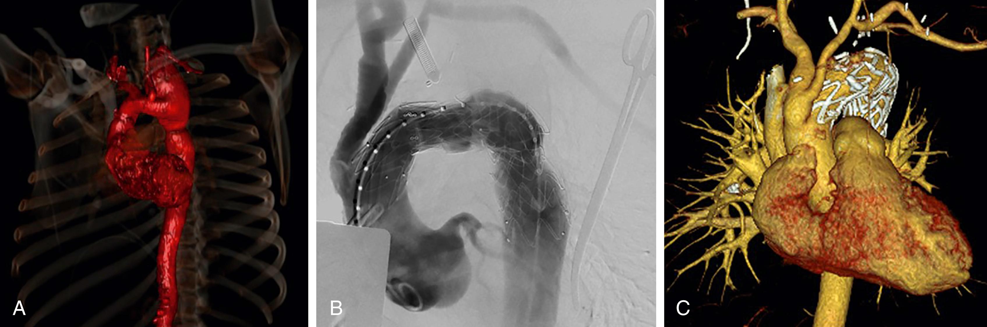 Figure 101.3, A 36-year-old patient with large LSCA aneurysm and no identifiable connective tissue disorder. Aneurysm, broad-based, obliterating the outer distal arch curve, causing pseudo-coarctation and significant arch tortuosity ( A ). Ascending aorta–innominate–LCCA bypass debranching with LCCA to LSCA CSB and SCA ligation away from the mediastinum, followed with TEVAR of arch to zone 0 ( B ). At 1 year, CTA shows SCA aneurysm treated well and sac excluded and significantly reduced with good perfusion throughout brachiocephalic reconstructions ( C ). This type of SAT aneurysm requires aortic-based management for occlusion.