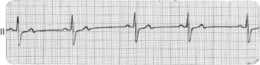 Fig. 133.2, In sinus bradycardia, there is a regular relationship between the P waves and QRS complexes. The rate is less than 60 beats per minute.