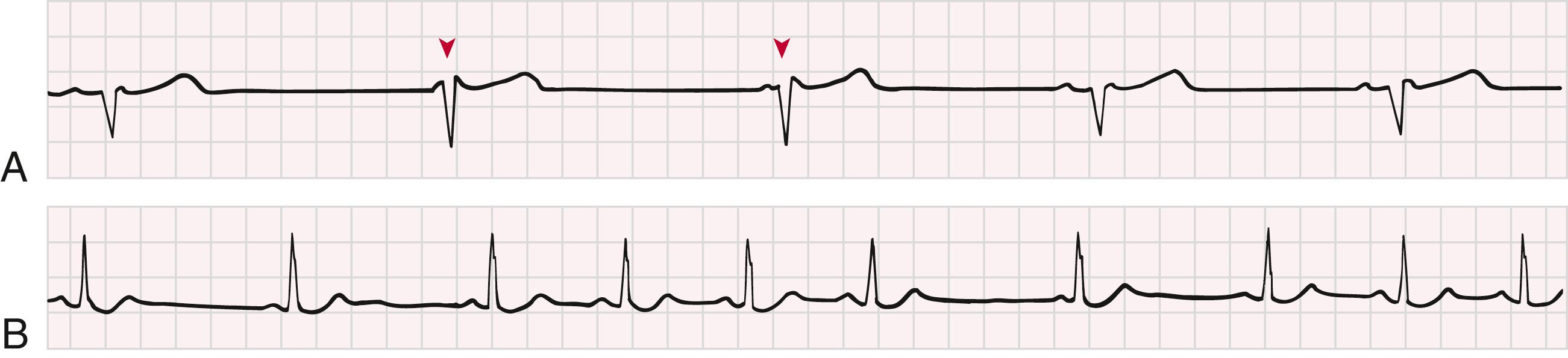 FIGURE 68.1, A, Sinus bradycardia at a rate of 40 to 48 beats/min. The second and third QRS complexes (arrowheads) represent junctional escape beats. Note the P waves at the onset of the QRS complex. B, Nonrespiratory sinus arrhythmia occurring as a consequence of digitalis toxicity. Monitor leads were used.