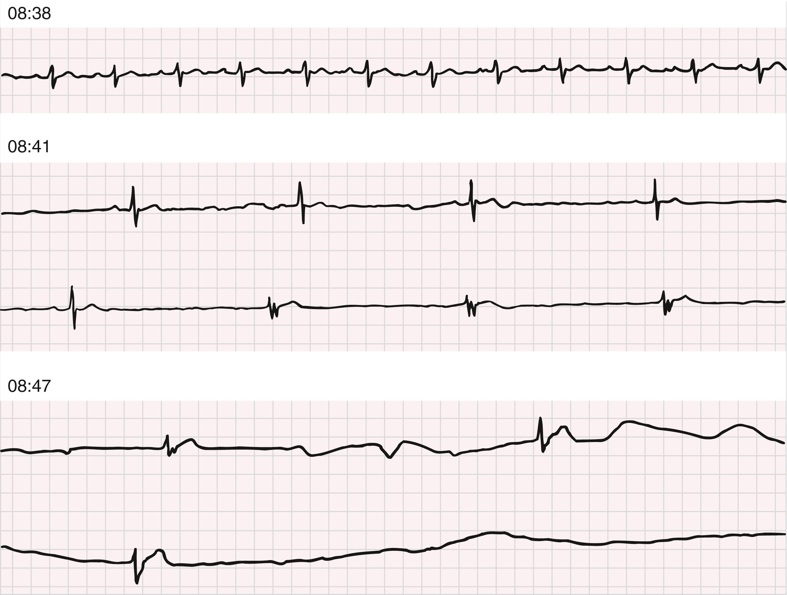 EFIGURE 68.1, Sinus arrest. The patient was wearing a long-term electrocardiographic recorder when he died suddenly of cardiac standstill. The rhythms demonstrate progressive sinus bradycardia and sinus arrest at 8:41 am . The rhythm then becomes a ventricular escape rhythm, which progressively slows and finally ceases at 8:47 am . The paired electrocardiographic strips are continuous recordings.