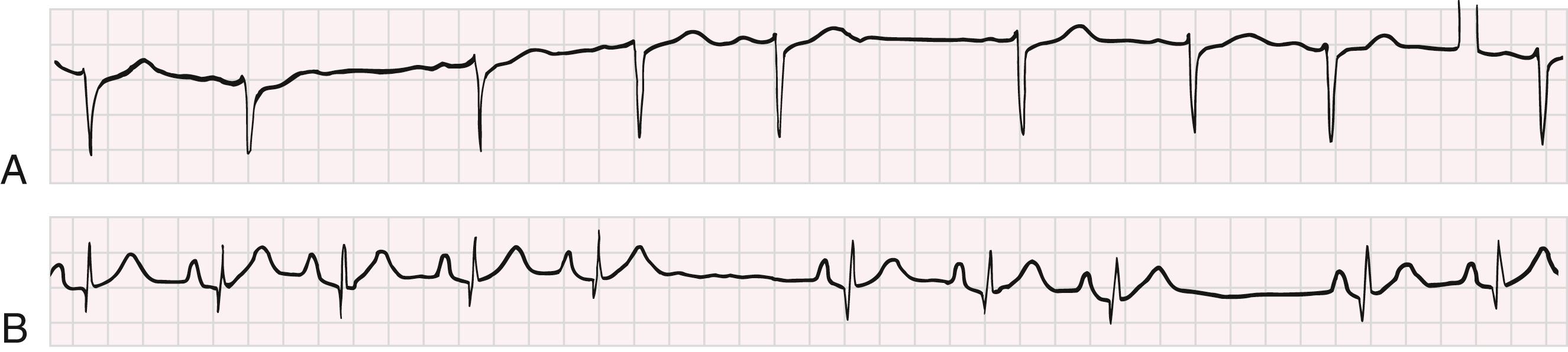 EFIGURE 68.2, Sinus nodal exit block. A, Type I sinoatrial (SA) nodal exit block has the following features. The P-P interval shortens from the first to the second cycle in each grouping, followed by a pause. The duration of the pause is less than twice the shortest cycle length, and the cycle after the pause exceeds the cycle before the pause. The PR interval is normal and constant. Lead V 1 is shown. B, The P-P interval varies slightly because of sinus arrhythmia. The two pauses in sinus nodal activity equal twice the basic P-P interval and are consistent with type II SA nodal exit block. The PR interval is normal and constant. Lead III recording is shown.