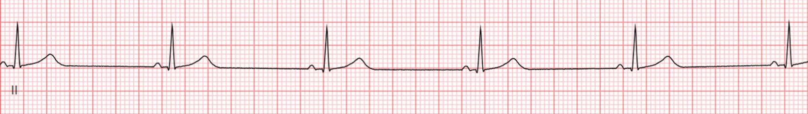 Fig. 9.1, Telemetry strip showing sinus bradycardia (rate of 47 bpm).