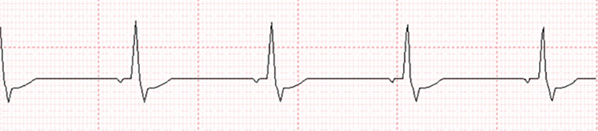 Fig. 11.1, Telemetry strip showing junctional bradycardia with inverted P and T waves with a narrow QRS complex.