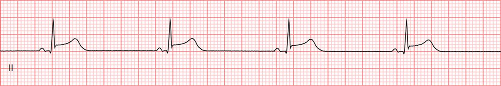 Fig. 10.1, Telemetry strip showing lead II–sinus bradycardia with ST changes.