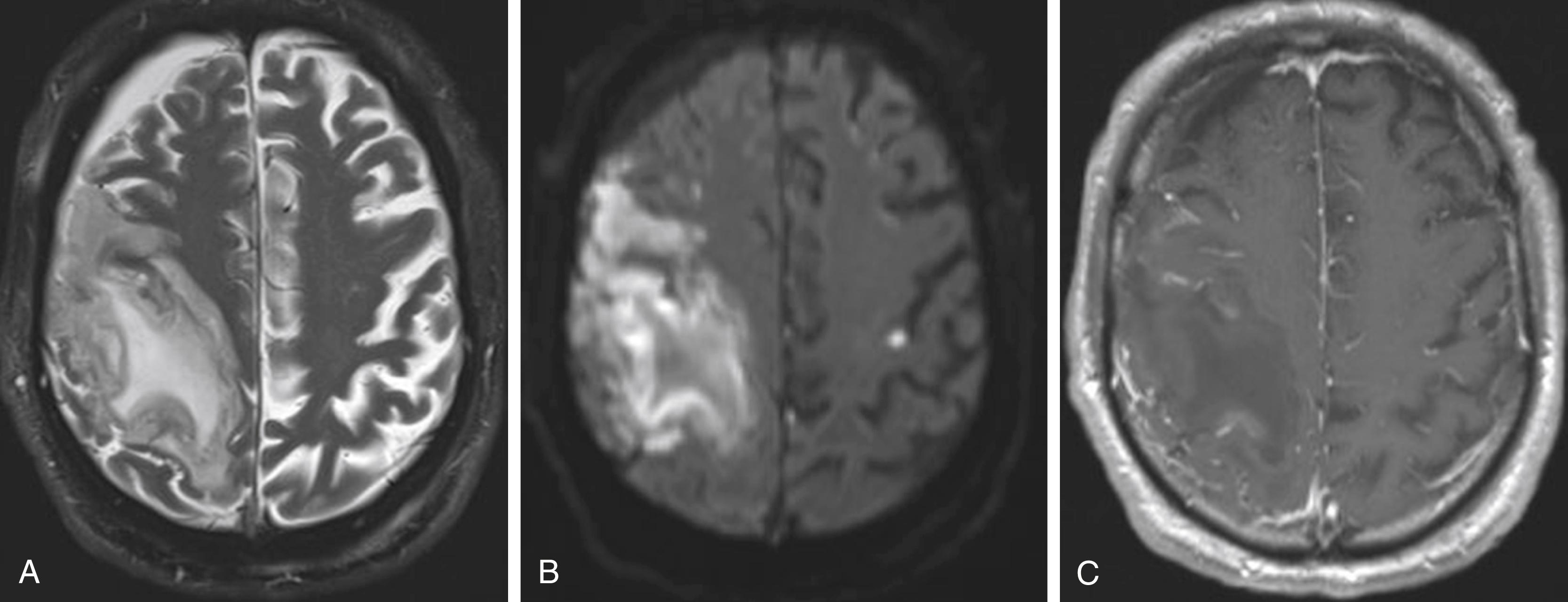 Figure 56.2, Day 5 after detection.