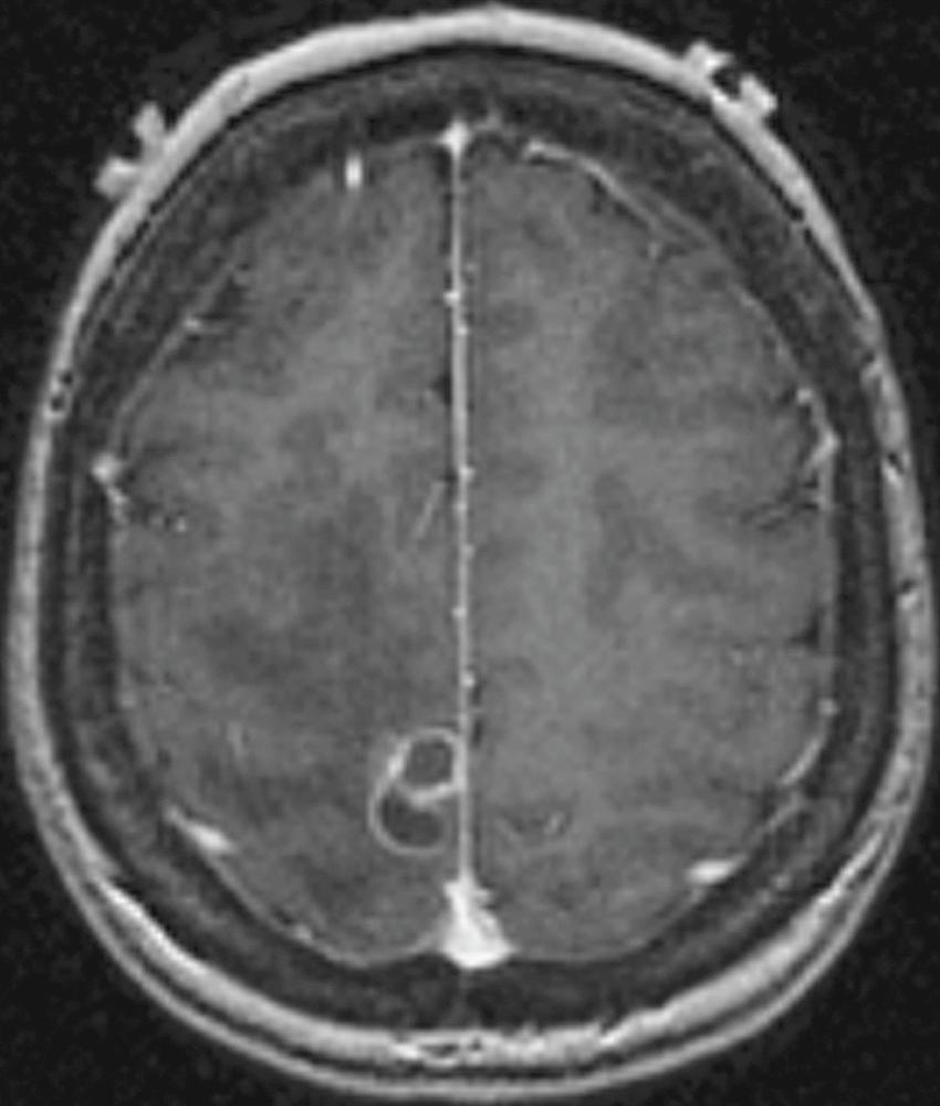 FIGURE 382-1, Brain abscess.