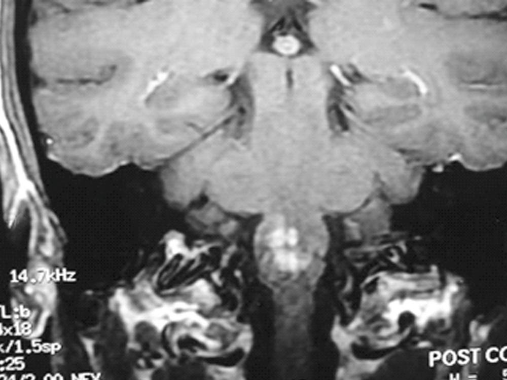 FIGURE 382-2, Brain stem abscess.