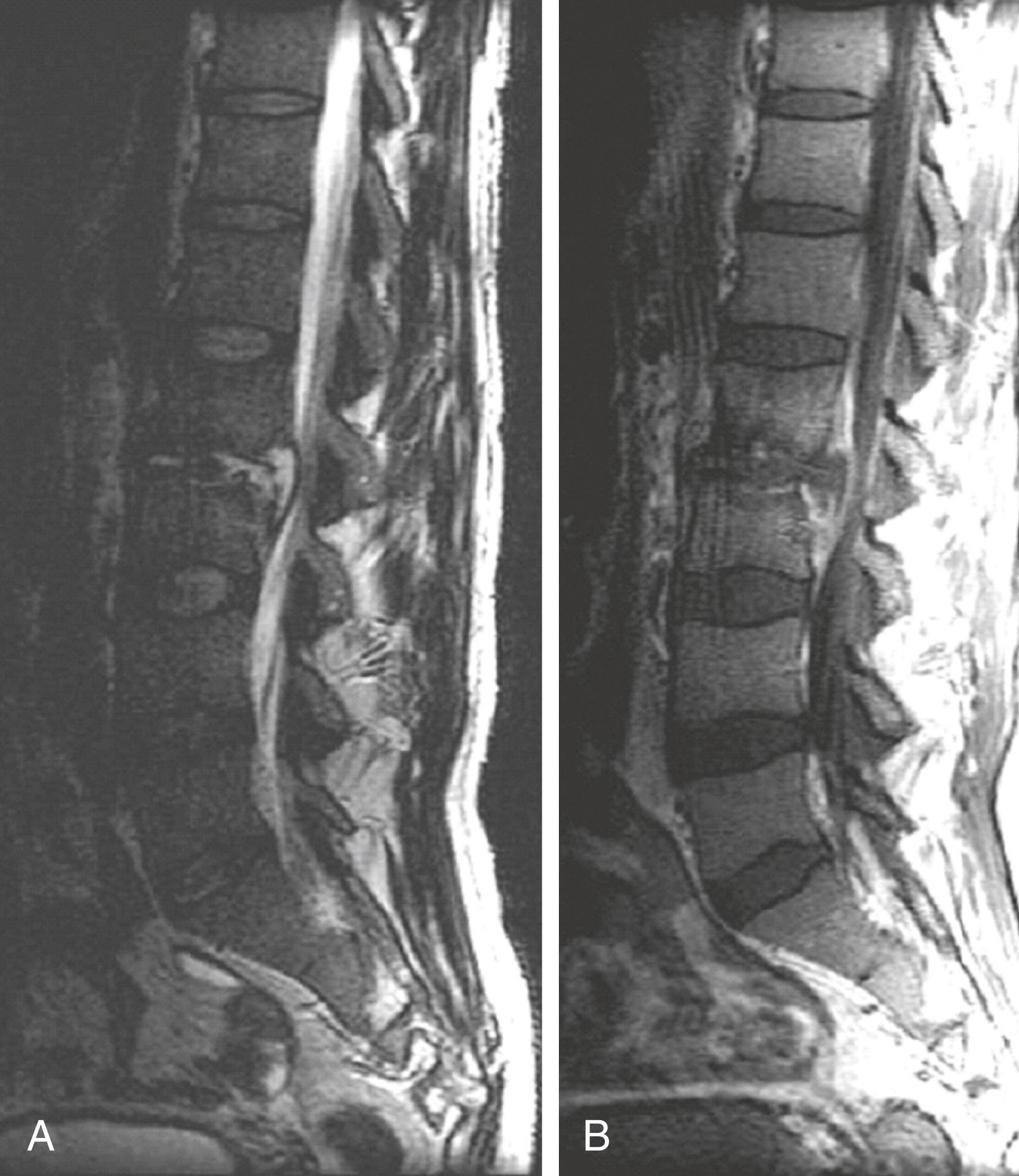 FIGURE 382-3, Spinal epidural abscess.