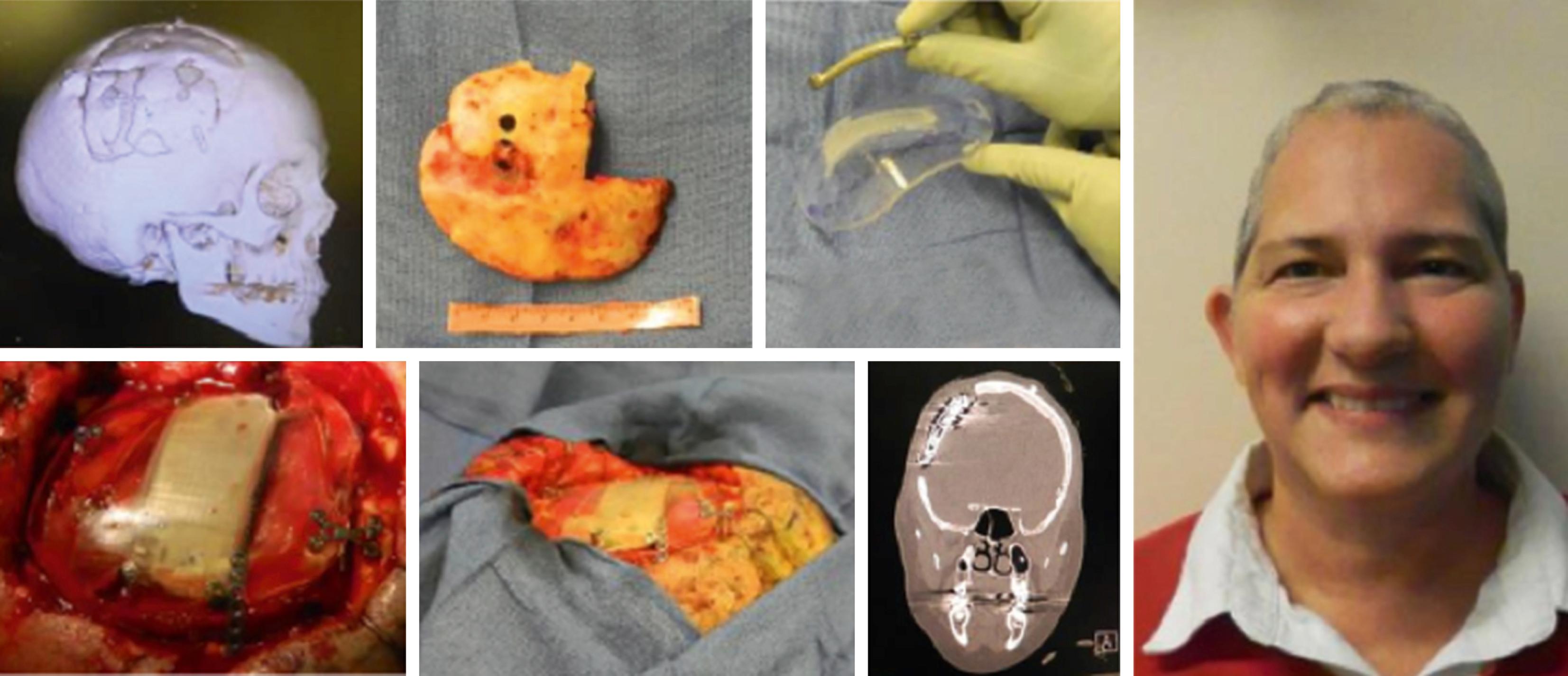 FIGURE 111.8, Images from a “first-in-human experience” article describing complete integration of a neuromodulation (brain-computer interface) device within a customized cranial implant—involving an epilepsy patient suffering from a large, acquired skull defect and coexisting need for implantable neurotechnology