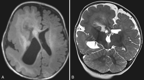 Figure 8.1, Hemimegalencephaly.