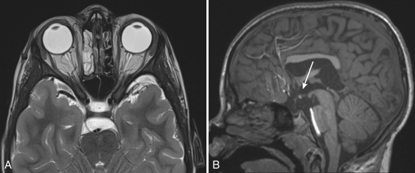 Figure 8.11, Septooptic dysplasia.