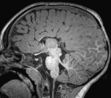 Figure 8.12, Agenesis of the corpus callosum.