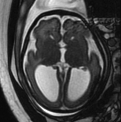 Figure 8.13, Colpocephaly.