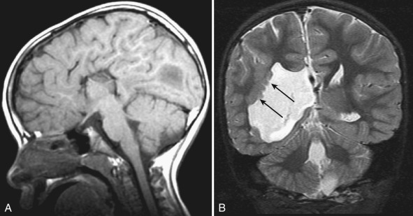 Figure 8.15, Aicardi syndrome.