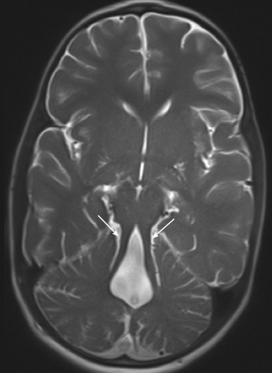 Figure 8.17, Joubert syndrome.