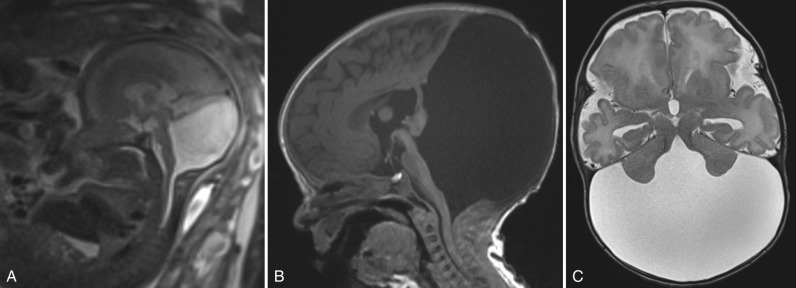 Figure 8.19, Dandy-Walker malformation.