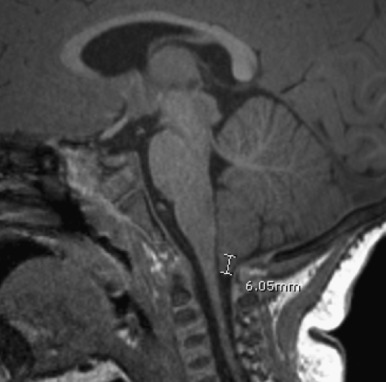 Figure 8.20, Chiari I malformation.