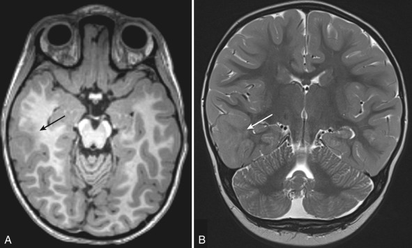 Figure 8.2, Focal cortical dysplasia.