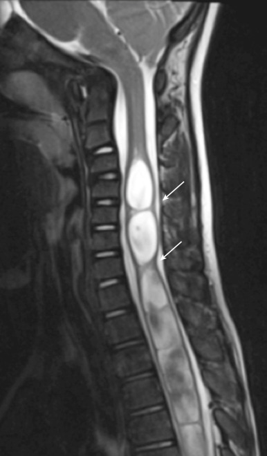 Figure 8.21, Chiari I malformation with hydromyelia.