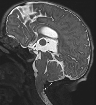 Figure 8.22, Chiari II malformation.