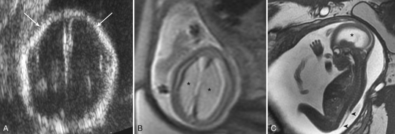 Figure 8.23, Chiari II malformation in a fetus.