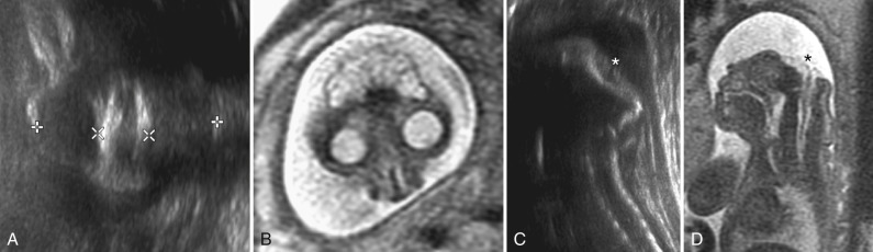 Figure 8.24, Anencephaly.